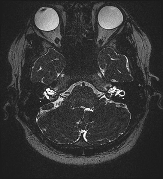 File:Cochlear incomplete partition type III associated with hypothalamic hamartoma (Radiopaedia 88756-105498 Axial T2 67).jpg