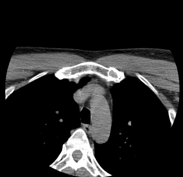 File:Colloid cyst of thyroid (Radiopaedia 22897-22923 Axial non-contrast 62).jpg