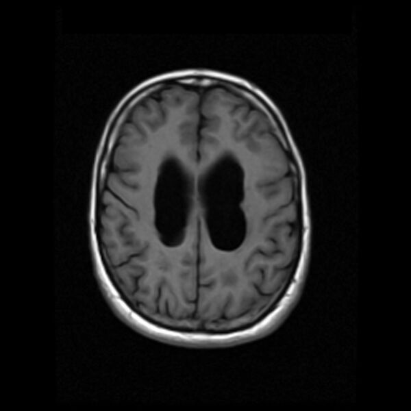 File:Colloid cyst with hydrocephalus (Radiopaedia 9373-10065 Axial T1 14).jpg