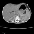 Colocolic fistula - Crohn disease (Radiopaedia 57063-63955 A 16).jpg