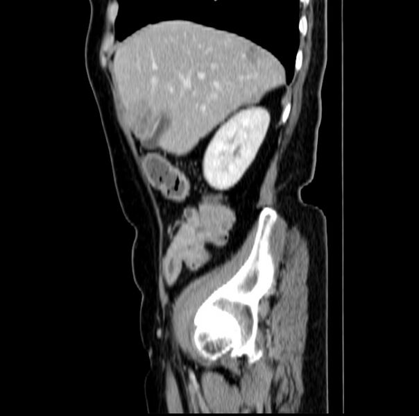 File:Colon carcinoma with hepatic metastases (Radiopaedia 29477-29961 C 14).jpg