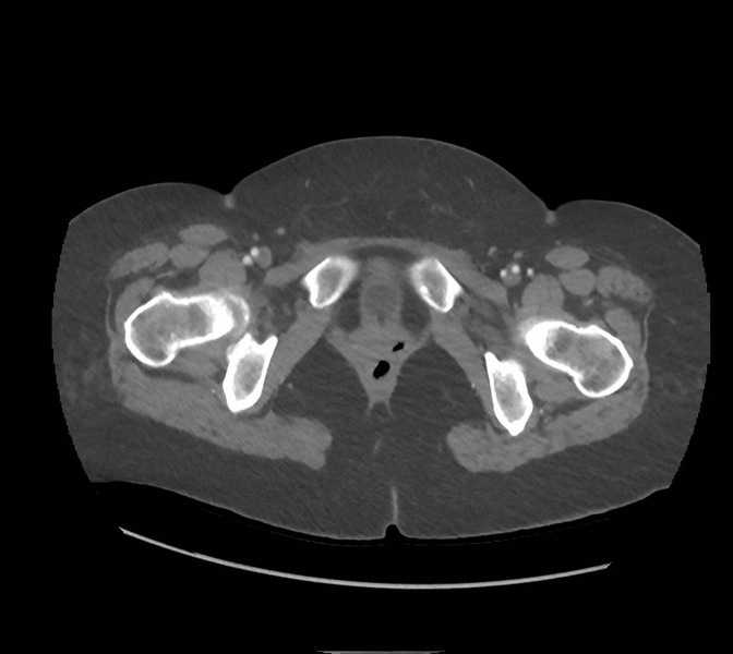 File:Colonic pseudo-obstruction (Radiopaedia 79752-92980 A 189).png