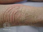 Kava ichthyosis (DermNet NZ scaly-ichthyosis-28).jpg
