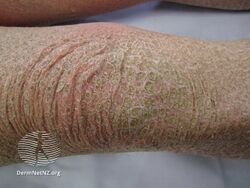 Kava ichthyosis (DermNet NZ scaly-ichthyosis-28).jpg