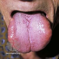 Macroglossia (due to systemic amyloidosis )