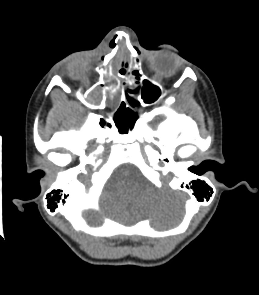 Nasoorbitoethmoid fracture (Radiopaedia 90044-107205 Axial non-contrast 144).jpg