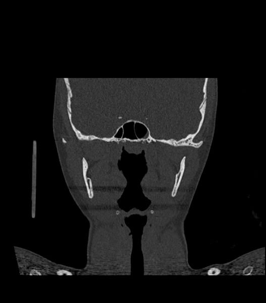 File:Nasoorbitoethmoid fracture (Radiopaedia 90044-107205 Coronal bone window 80).jpg