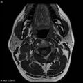 Nasopharyngeal carcinoma (Radiopaedia 4546-6667 Axial T1 15).jpg