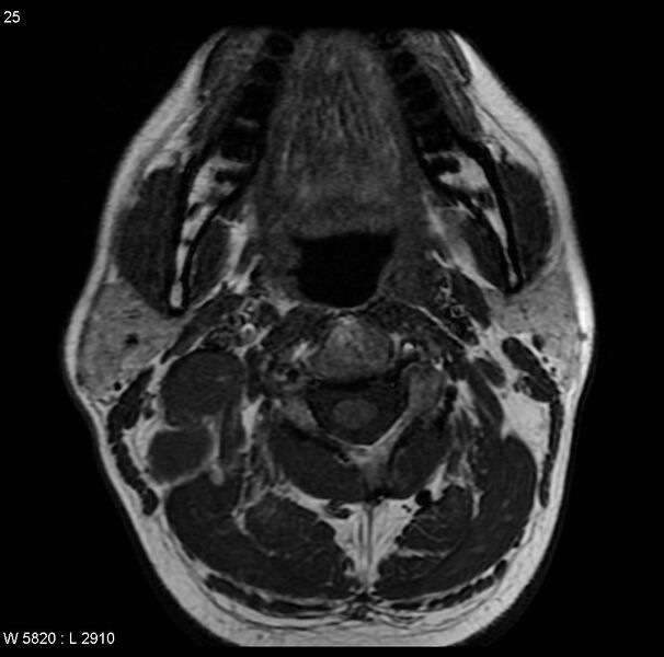File:Nasopharyngeal carcinoma (Radiopaedia 4546-6667 Axial T1 15).jpg