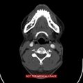 Nasopharyngeal carcinoma recurrence - skull base destruction (Radiopaedia 29107-29491 A 22).jpg
