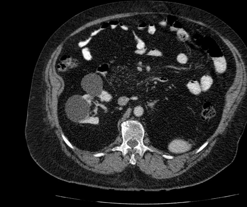 Nephroptosis with inguinal hernia containing perirenal fat (Radiopaedia 56632-63391 C 142).jpg