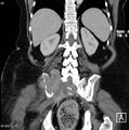 Nerve sheath tumor - malignant - sacrum (Radiopaedia 5219-6987 B 11).jpg