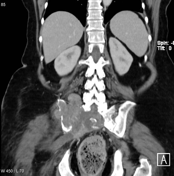 File:Nerve sheath tumor - malignant - sacrum (Radiopaedia 5219-6987 B 11).jpg