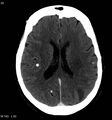 Neurocysticercosis (Radiopaedia 7773-8596 C+ delayed 10).jpg