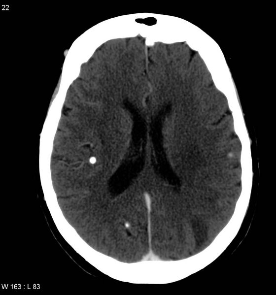 File:Neurocysticercosis (Radiopaedia 7773-8596 C+ delayed 10).jpg