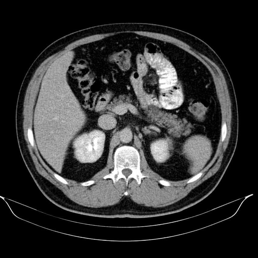 Neuroendocrine tumor of head of pancreas (Radiopaedia 57538-64502 D 29).jpg