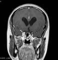 Neurofibromatosis type 2 - cranial and spinal involvement (Radiopaedia 5351-7111 Coronal T1 C+ 1).jpg