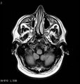 Neurosarcoidosis (Radiopaedia 10930-11351 Axial FLAIR 2).jpg