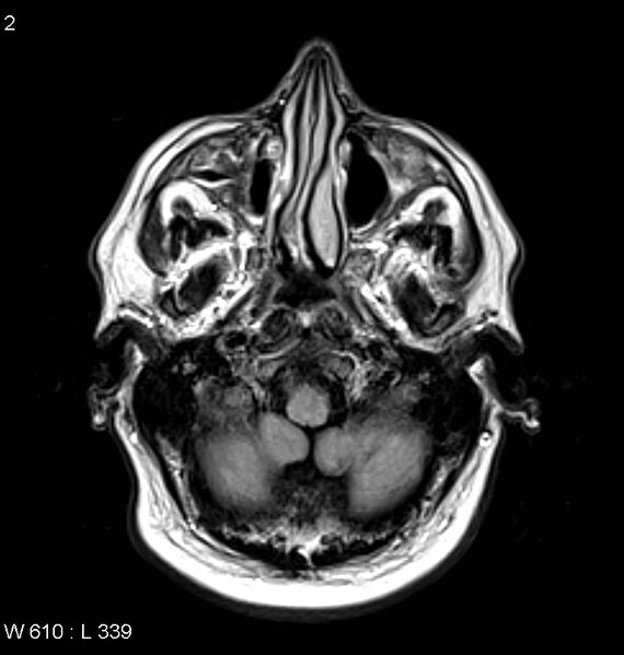 File:Neurosarcoidosis (Radiopaedia 10930-11351 Axial FLAIR 2).jpg