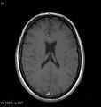 Neurosarcoidosis (Radiopaedia 10930-11351 Axial T1 C+ 12).jpg