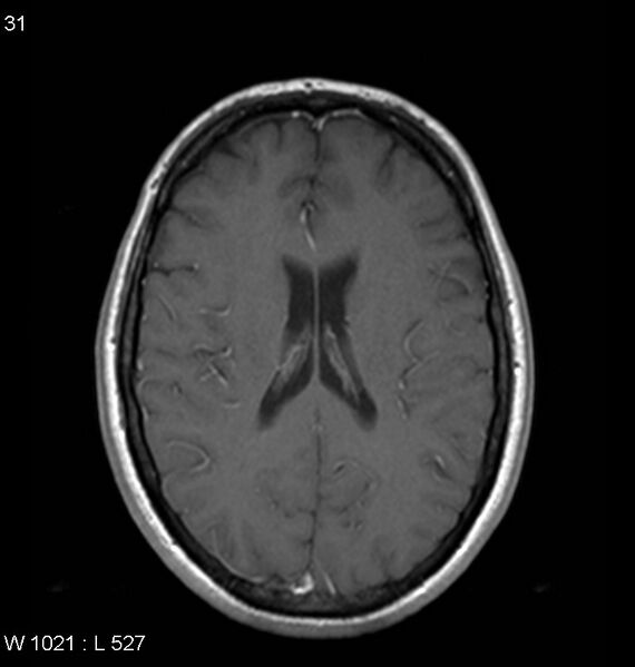 File:Neurosarcoidosis (Radiopaedia 10930-11351 Axial T1 C+ 12).jpg