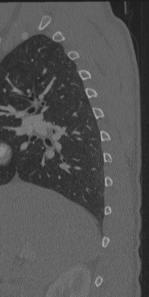 File:Normal CT thoracic spine (Radiopaedia 40181-42688 Sagittal bone window 63).png