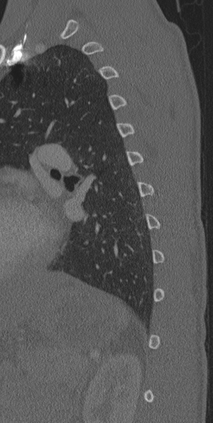 File:Normal CT thoracic spine (Radiopaedia 40181-42688 Sagittal bone window 7).png