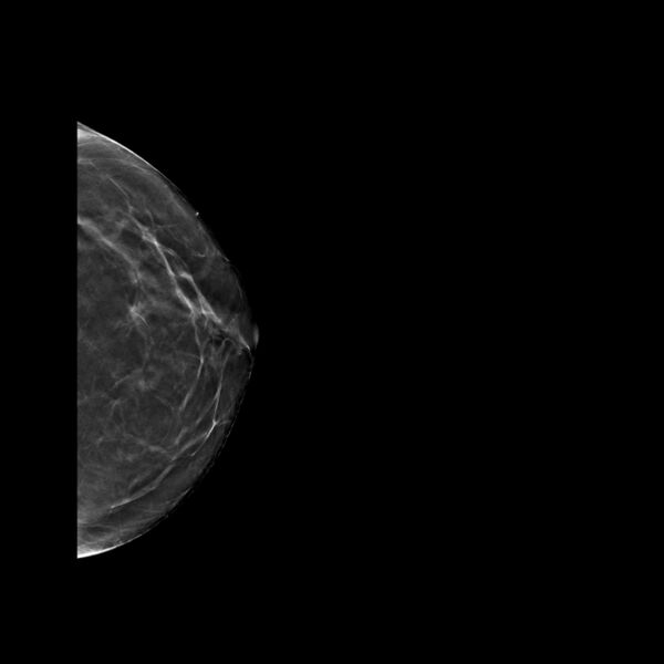 File:Normal breast mammography (tomosynthesis) and ultrasound (Radiopaedia 65325-74353 LCC Tomo 28).jpeg
