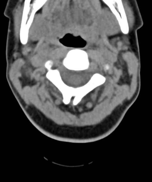 File:Normal cervical spine MRI (including Dixon) (Radiopaedia 42762-45926 Axial non-contrast 19).png