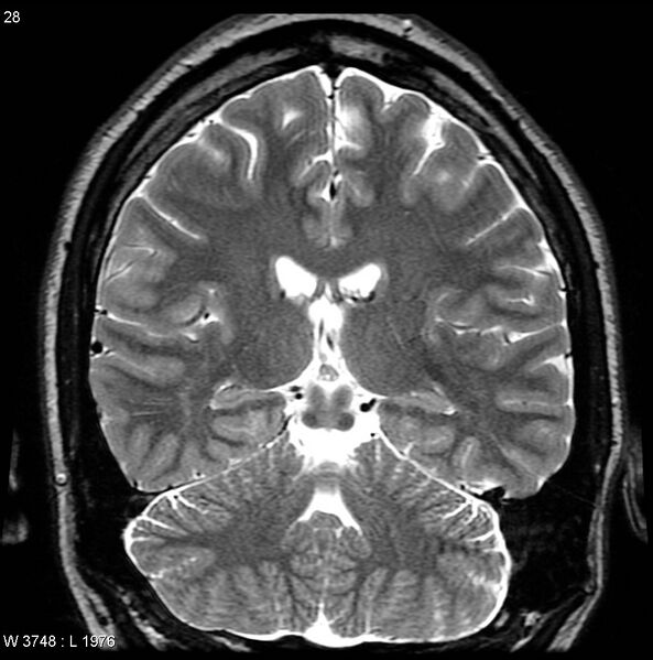 File:Normal coronal brain (Radiopaedia 6676-7910 Coronal T2 28).jpg
