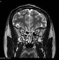 Normal coronal brain (Radiopaedia 6676-7910 Coronal T2 8).jpg