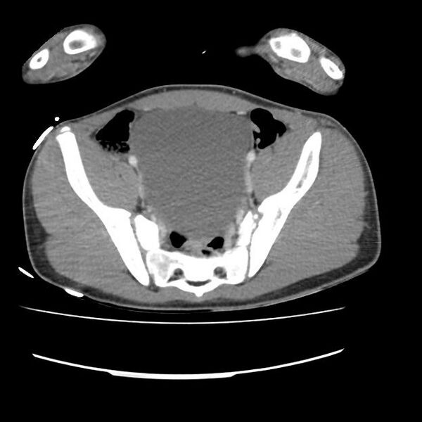 File:Normal dual-phase trauma CT chest,abdomen and pelvis (Radiopaedia 48092-52899 A 97).jpg