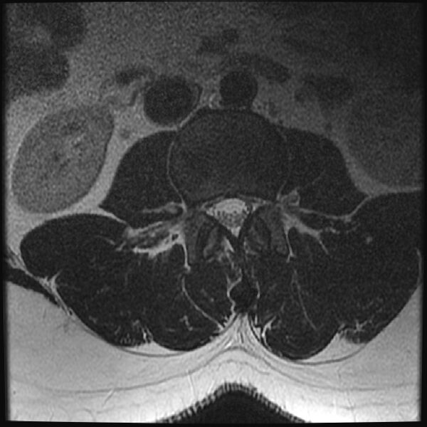 File:Normal lumbar spine MRI (Radiopaedia 43051-46311 Axial T2 10).jpg