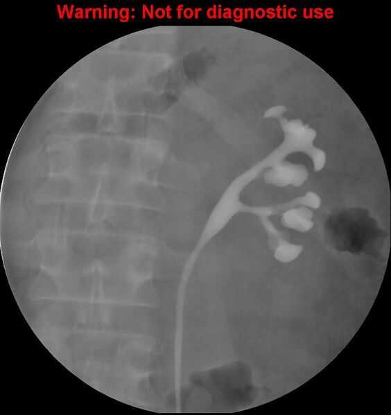 File:Normal retrograde pyelography of a native and transplant kidney (Radiopaedia 40480-43054 Native kidney 9).jpg