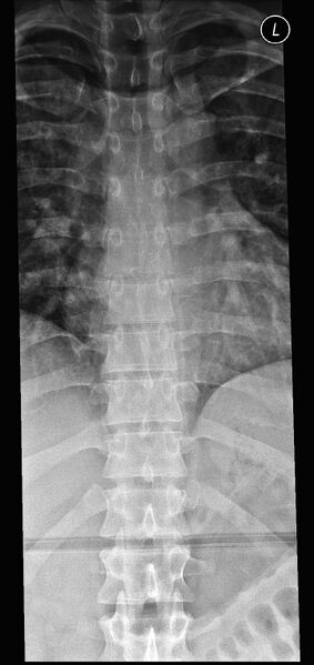 File:Normal trauma spine imaging (Radiopaedia 31753-32687 Frontal 1).jpg