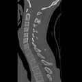 Normal trauma spine imaging (age 16) (Radiopaedia 45335-49358 Sagittal bone window 17).jpg