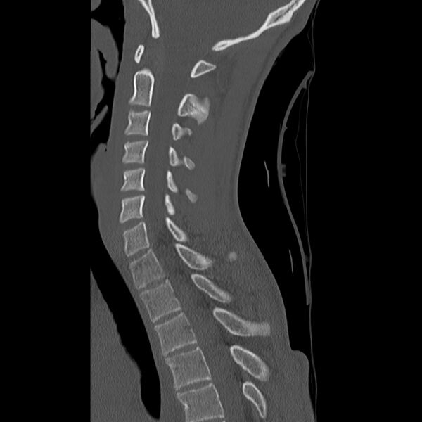 File:Normal trauma spine imaging (age 16) (Radiopaedia 45335-49358 Sagittal bone window 17).jpg