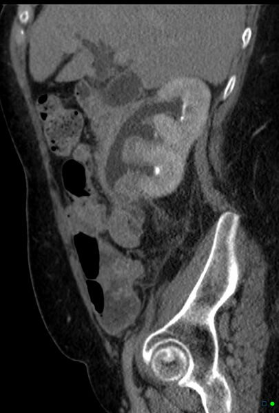 File:Obstructed infected horseshoe kidney (Radiopaedia 18116-17898 E 1).jpg