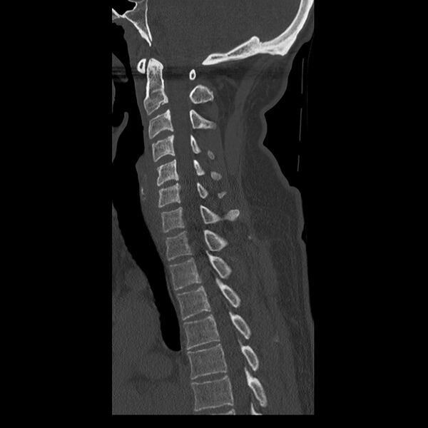 File:Occipital condyle fracture (Radiopaedia 31755-32691 Sagittal bone window 18).jpg
