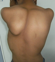 Scapula is displaced medially and superiorly
