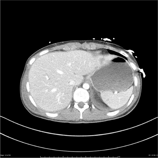 File:Traumatic renal artery dissection and pancreatic transection (Radiopaedia 37061-38739 Axial 277).jpg