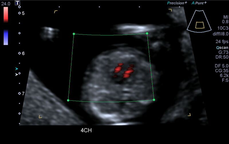 File:1st trimester nuchal-morphology ultrasound (Radiopaedia 44706-48477 Heart views cine with colour 29).jpg