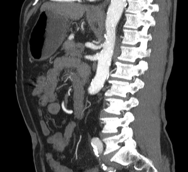 File:Abdominal aortic aneurysm (Radiopaedia 22421-22458 D 25).jpg