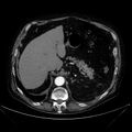 Abdominal aortic aneurysm (Radiopaedia 25855-26001 Axial C+ arterial phase 34).jpg