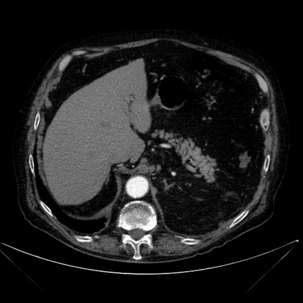 File:Abdominal aortic aneurysm (Radiopaedia 25855-26001 Axial C+ arterial phase 34).jpg