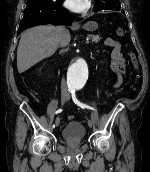 File:Abdominal aortic aneurysm (Radiopaedia 25855-26001 Coronal C+ arterial phase 30).jpg