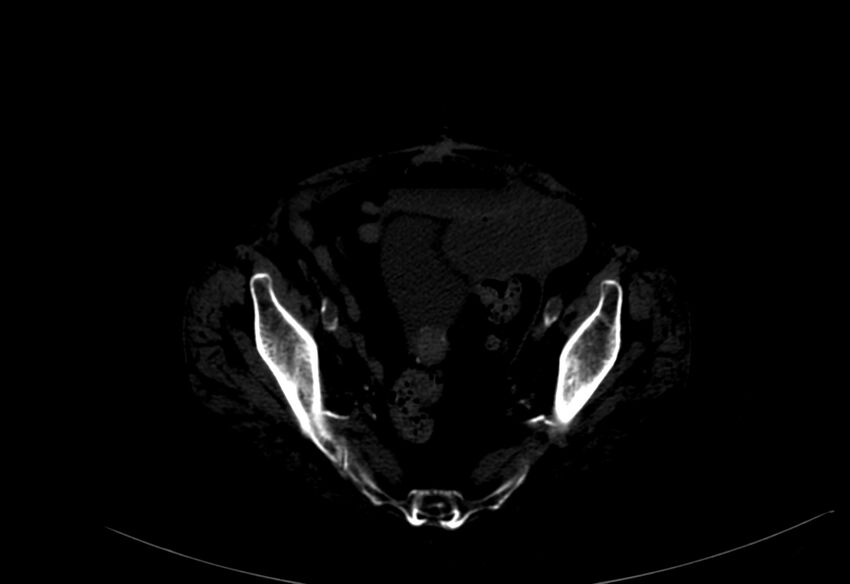 Abdominal aortic aneurysm - impending rupture (Radiopaedia 19233-19246 B 54).jpg