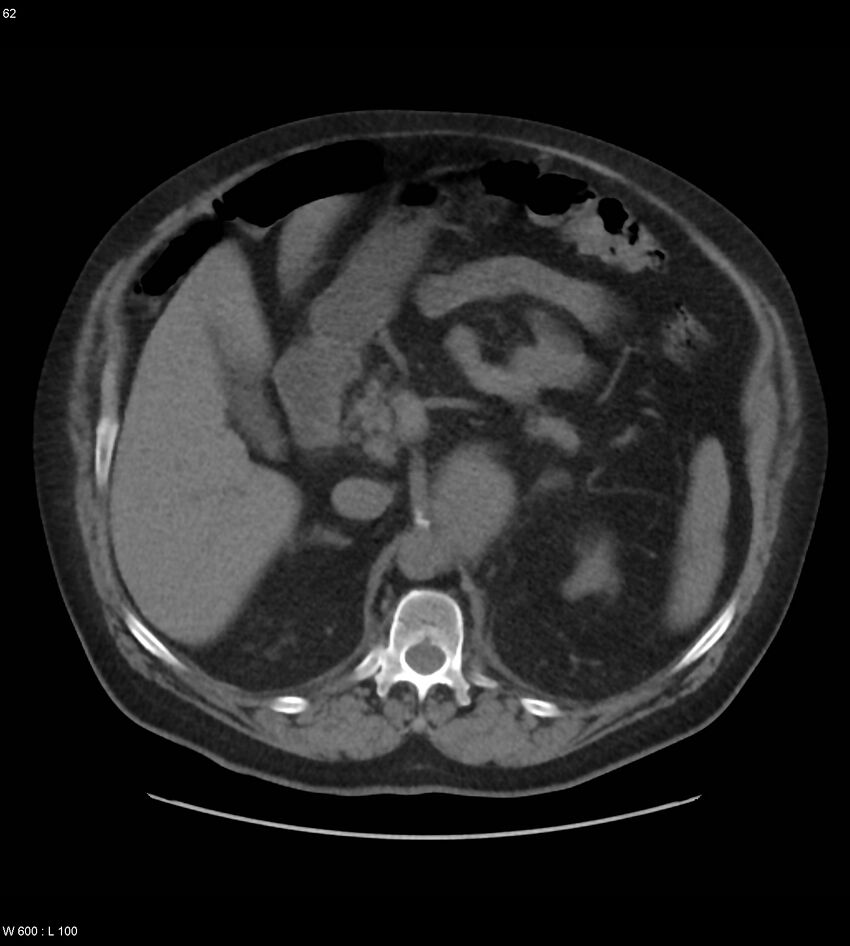 Abdominal aortic aneurysm with intramural hematoma then rupture (Radiopaedia 50278-55631 Axial non-contrast 58).jpg