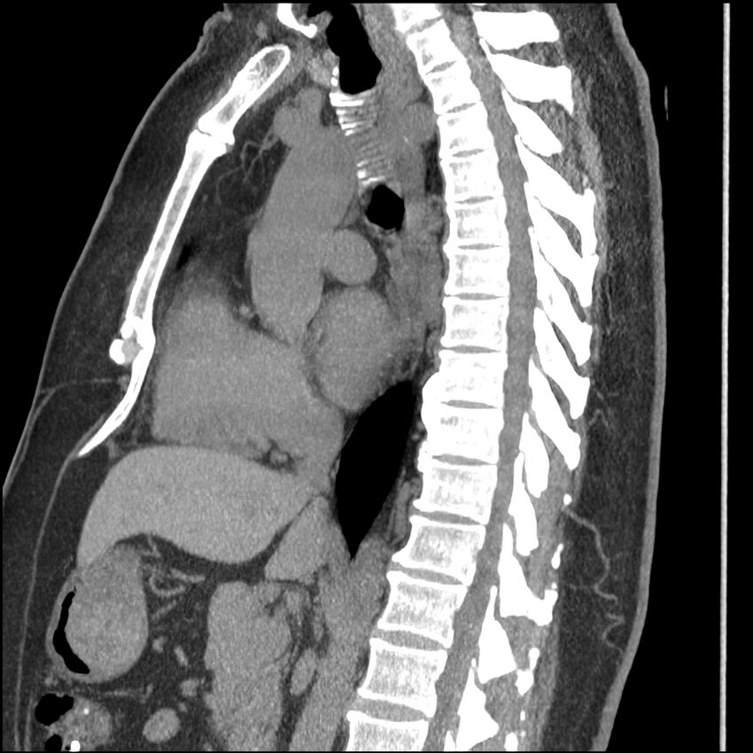 Aberrant right subclavian artery (Radiopaedia 40967-43680 Sagittal non-contrast 43).jpg