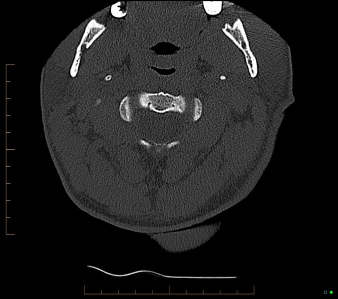 File:Accessory articulation of cervical transverse processes (Radiopaedia 82715-96933 Axial non-contrast 25).jpg